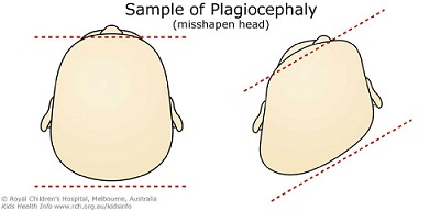 Plagiocephaly – misshapen head