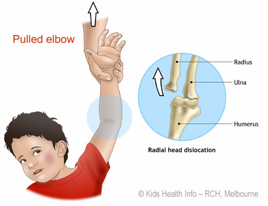 nursemaid elbow, pulled elbow