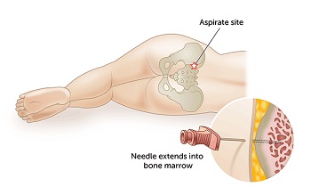 Bone marrow aspirate