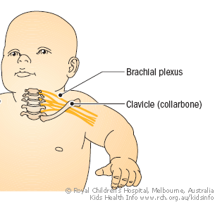 Kids Health Information : Brachial plexus palsy or Erb’s palsy