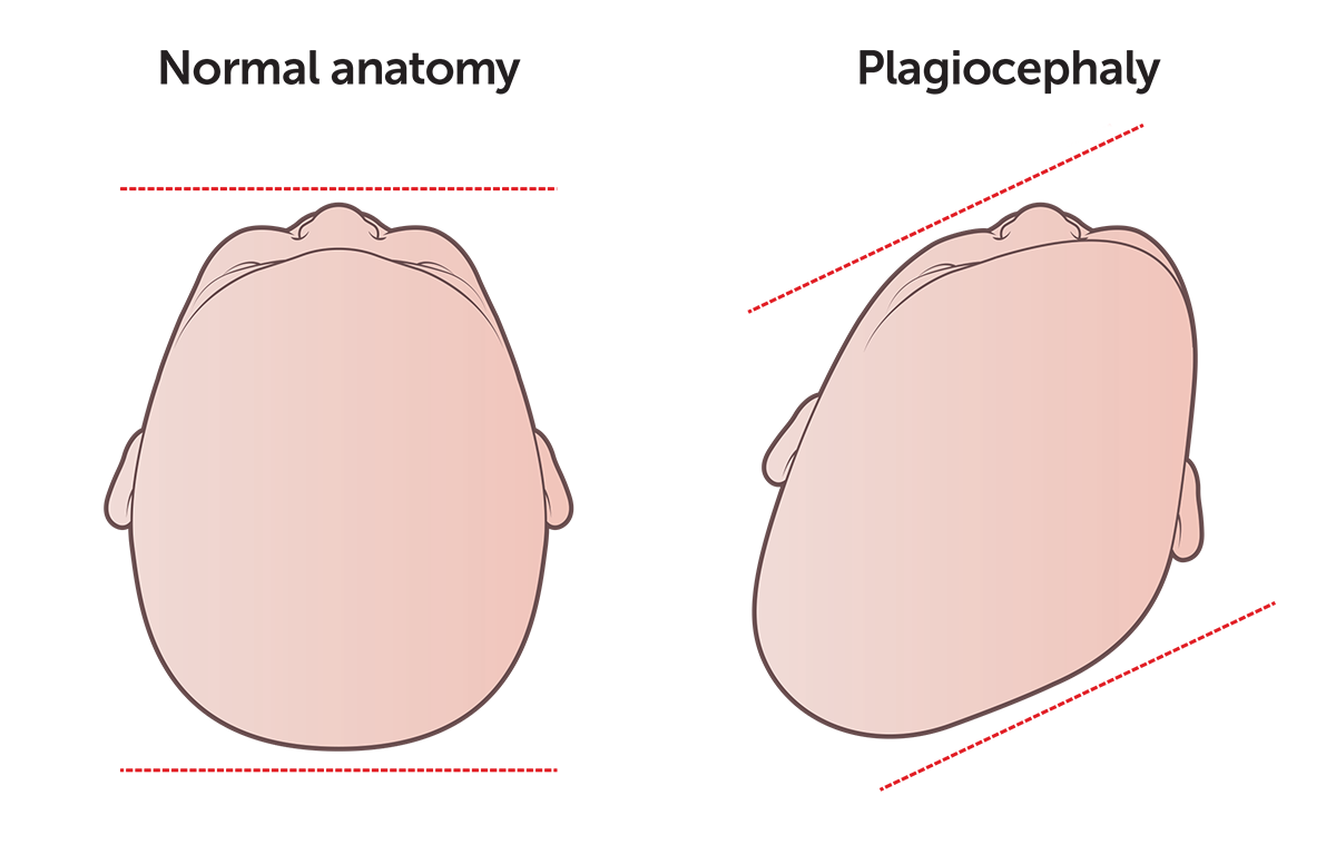 Kids Health Info : Plagiocephaly and brachycephaly - misshapen head
