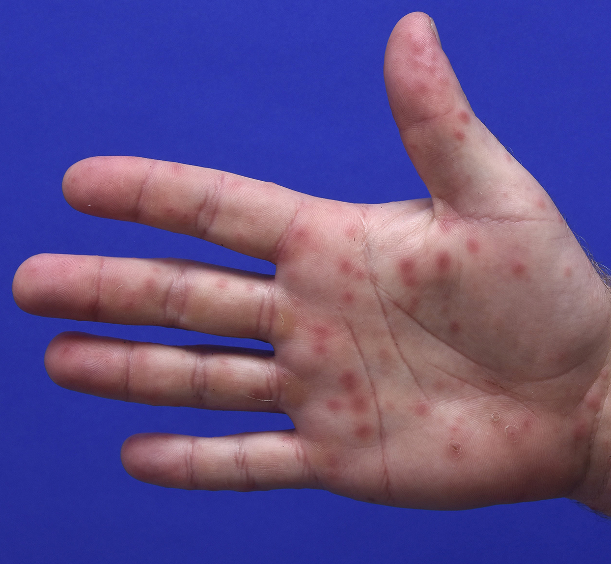 Pale-skin hand with red spots and blisters from hand, foot and mouth disease. Hand is in front of blue background.