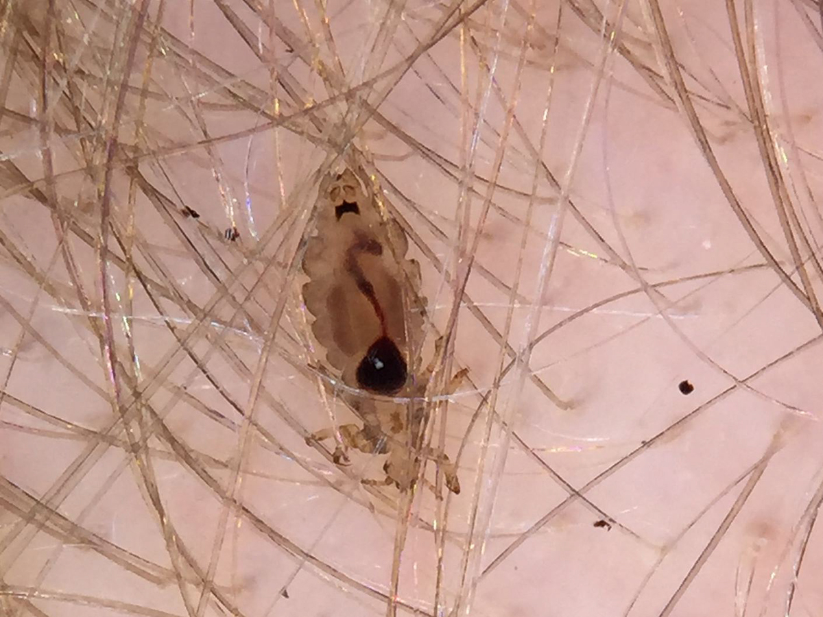 Close-up photo of a single head louse on a pale scalp.
