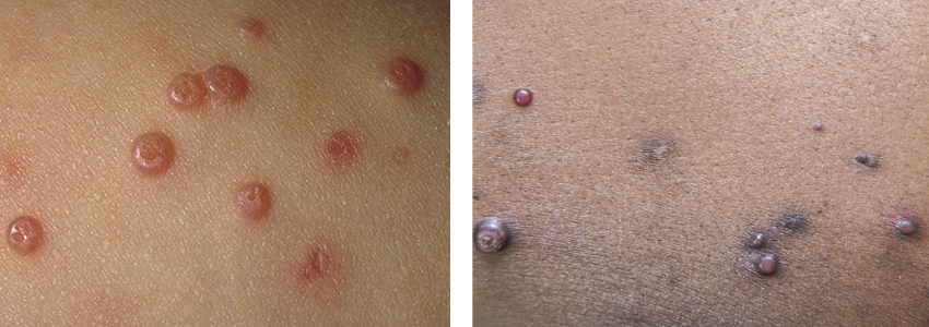 Two images of molluscum spots on different skin tones. Image on the left shows red molluscum spots on pale skin, and image on the right show purple molluscum spots on dark skin.