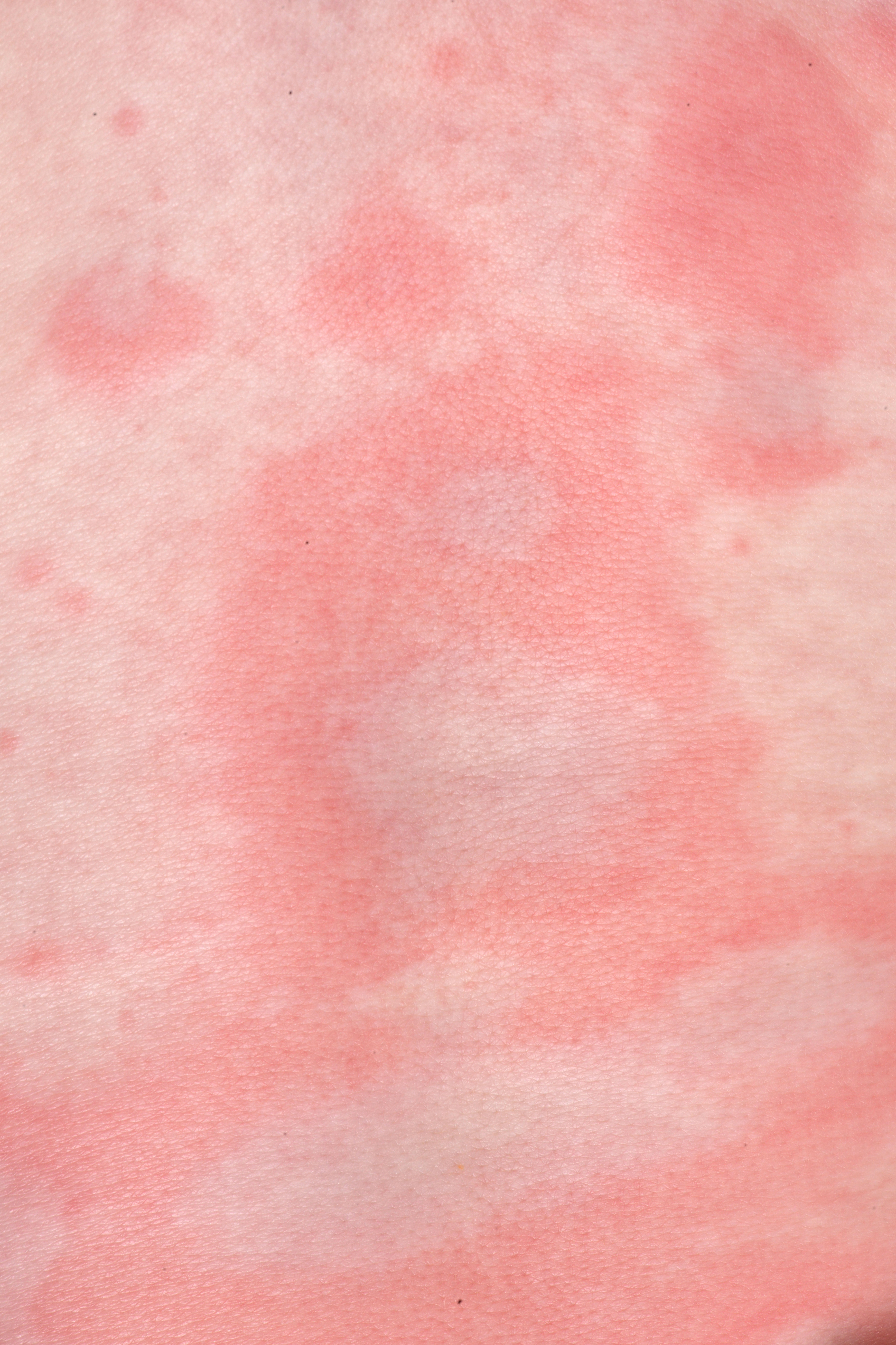 Photograph of as cluster of hives wheals on pale skin; the wheals are red on the outside and white in the middle