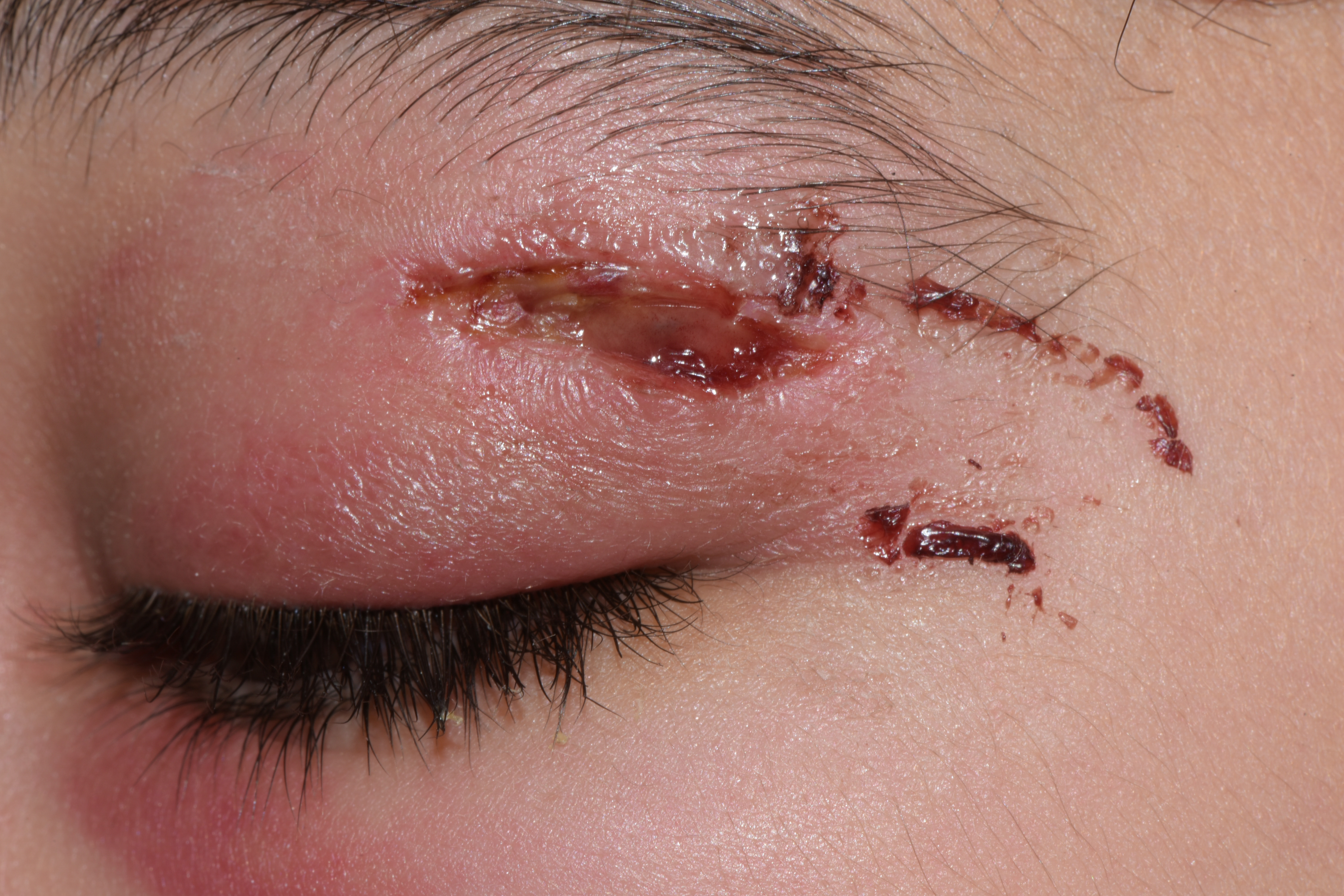 Child with infected wound on eyelid; the eye area is red, swollen, and the wound is oozing pus