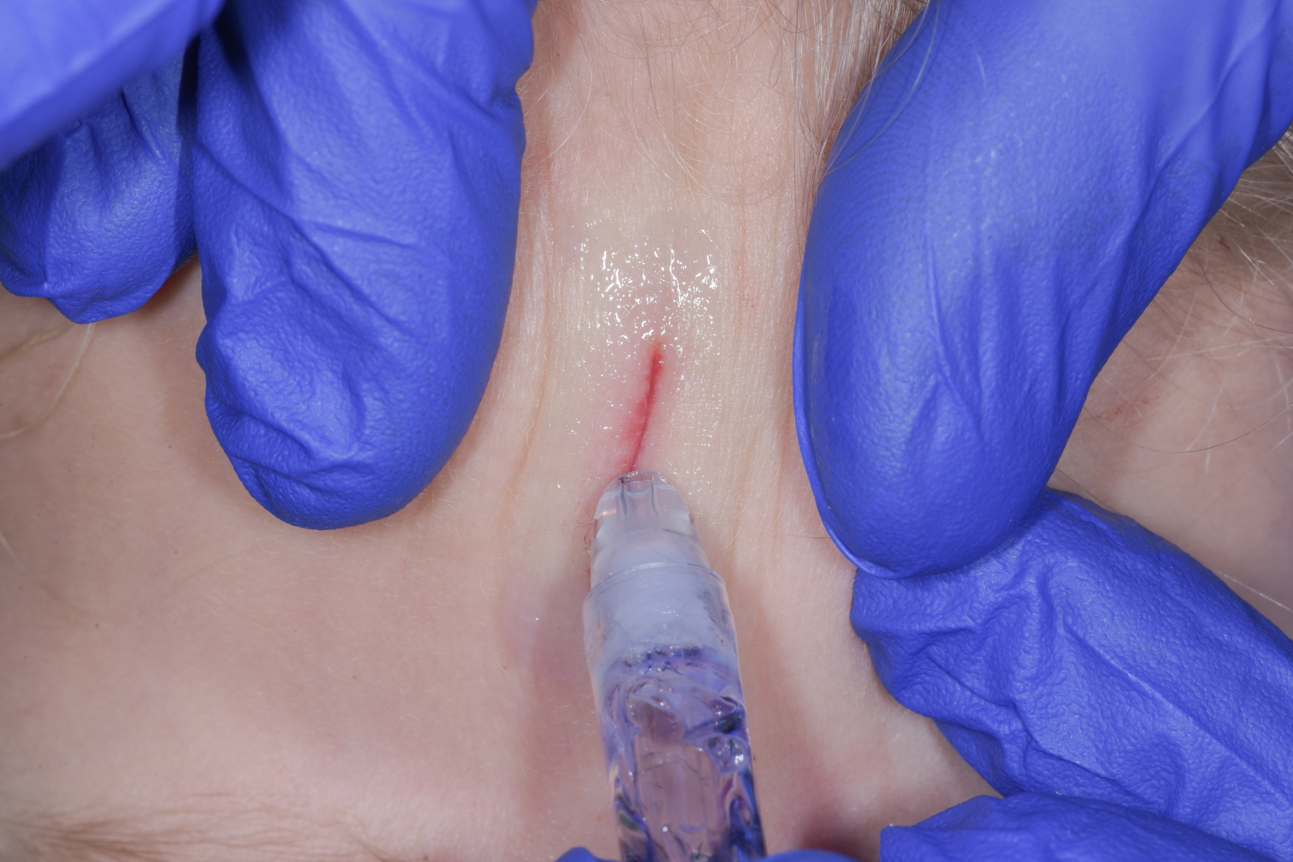 Young child with pale skin having a forehead wound glued together by doctor in blue surgical gloves.