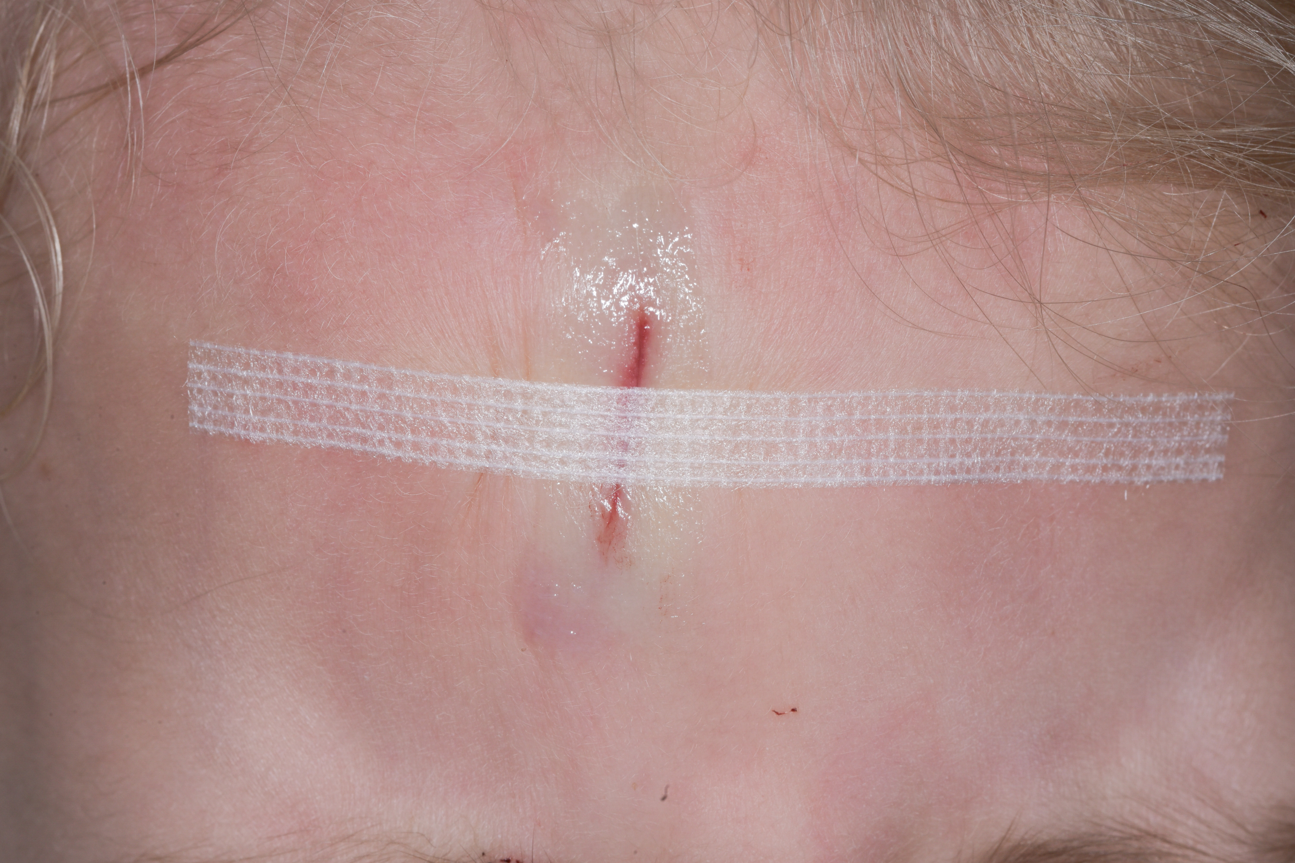 Young child with a forehead wound glued together, and a wound closure strip on top