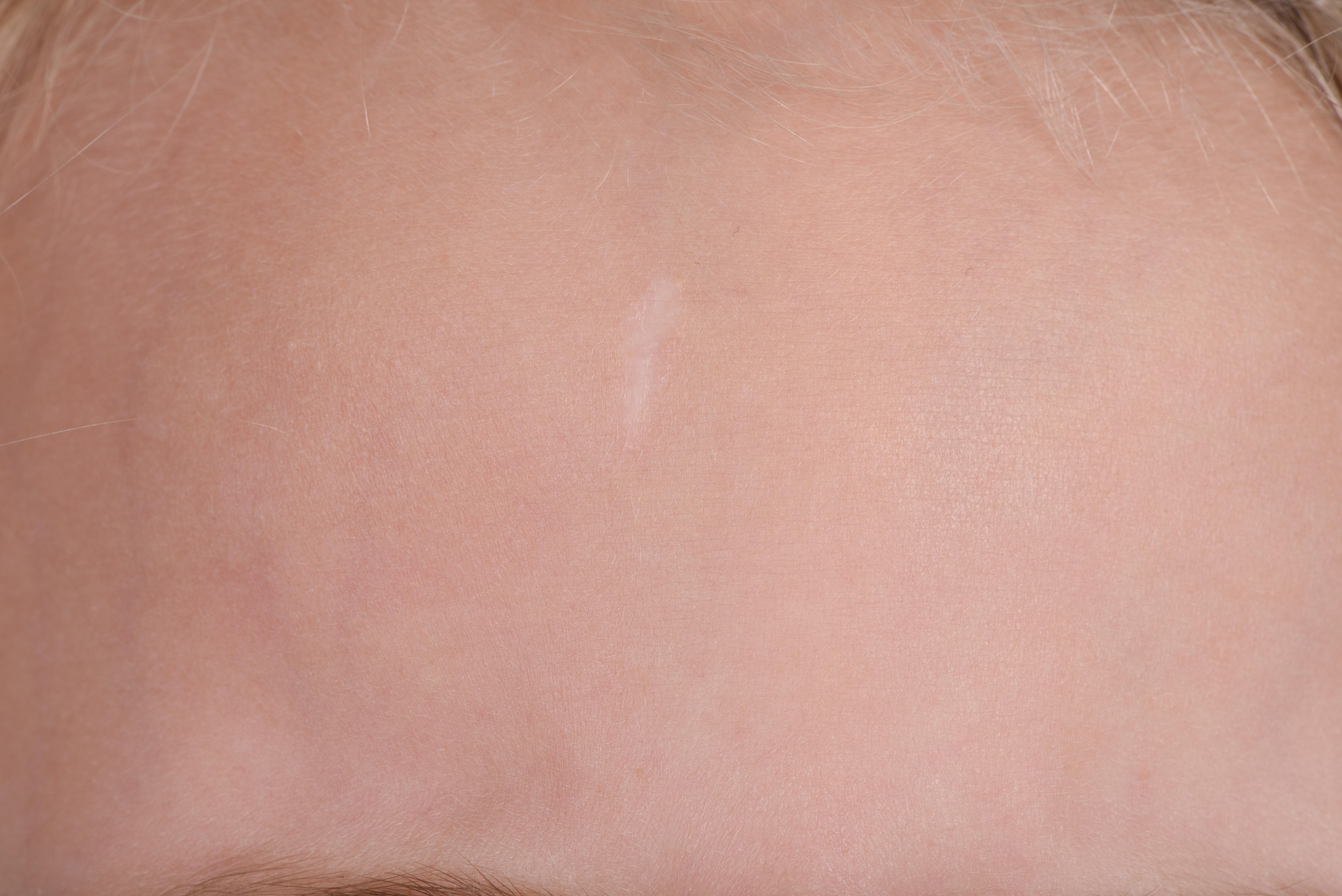 Young child with pale skin and a white healed scar