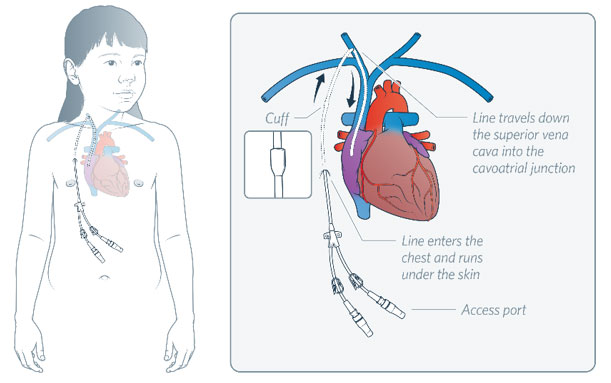 CVAD: Tunnelled Cuffed - Centrally Inserted Central Catheter (TC-CICC)