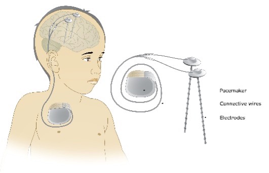 Deep brain stimulation device