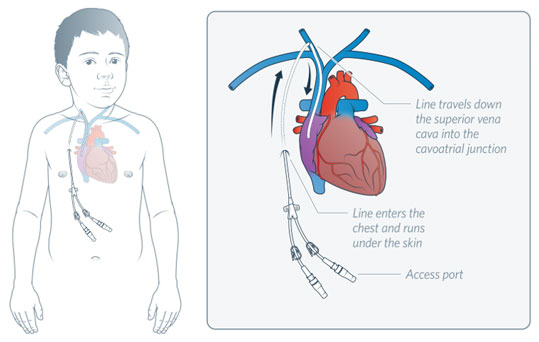 CVAD: Tunnelled – Centrally Inserted Central Catheter 