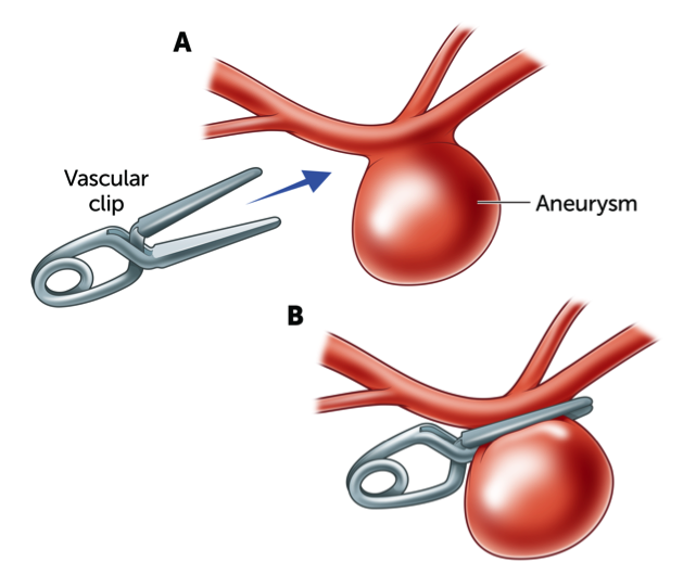 Cerebral Aneurysm 2