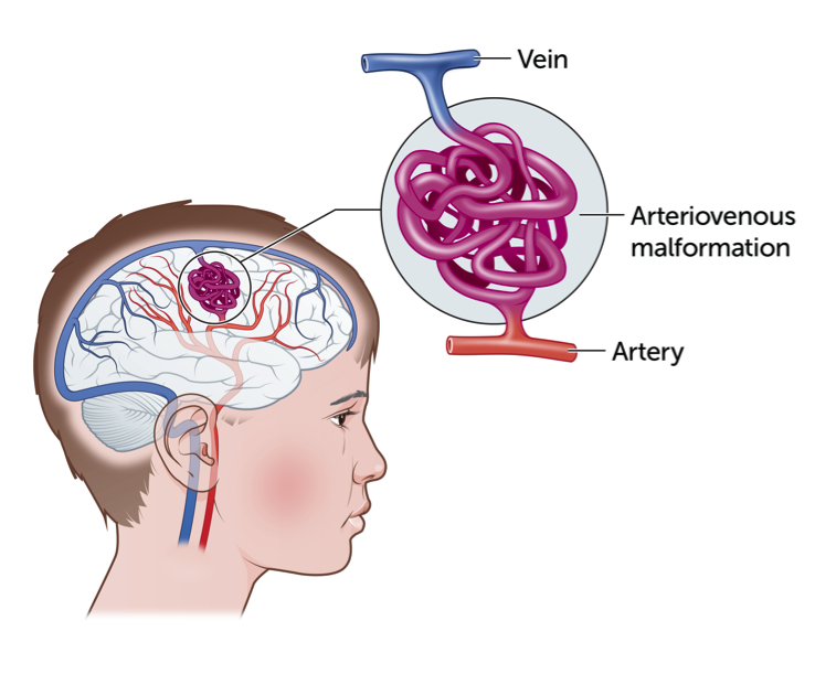 Cerebral Arteriovenous Malformation (AVM) 