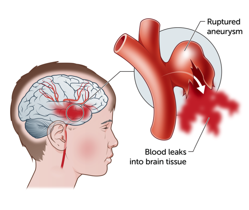 Kids Health Information : Haemorrhagic Stroke