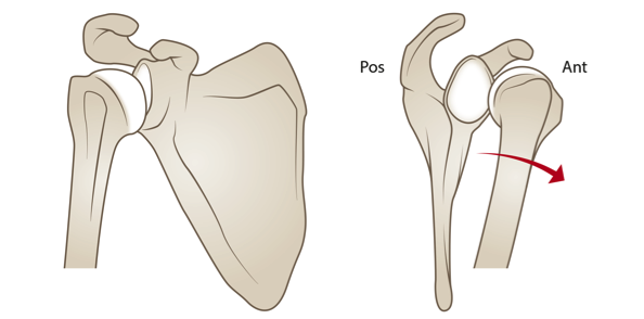 dislocation