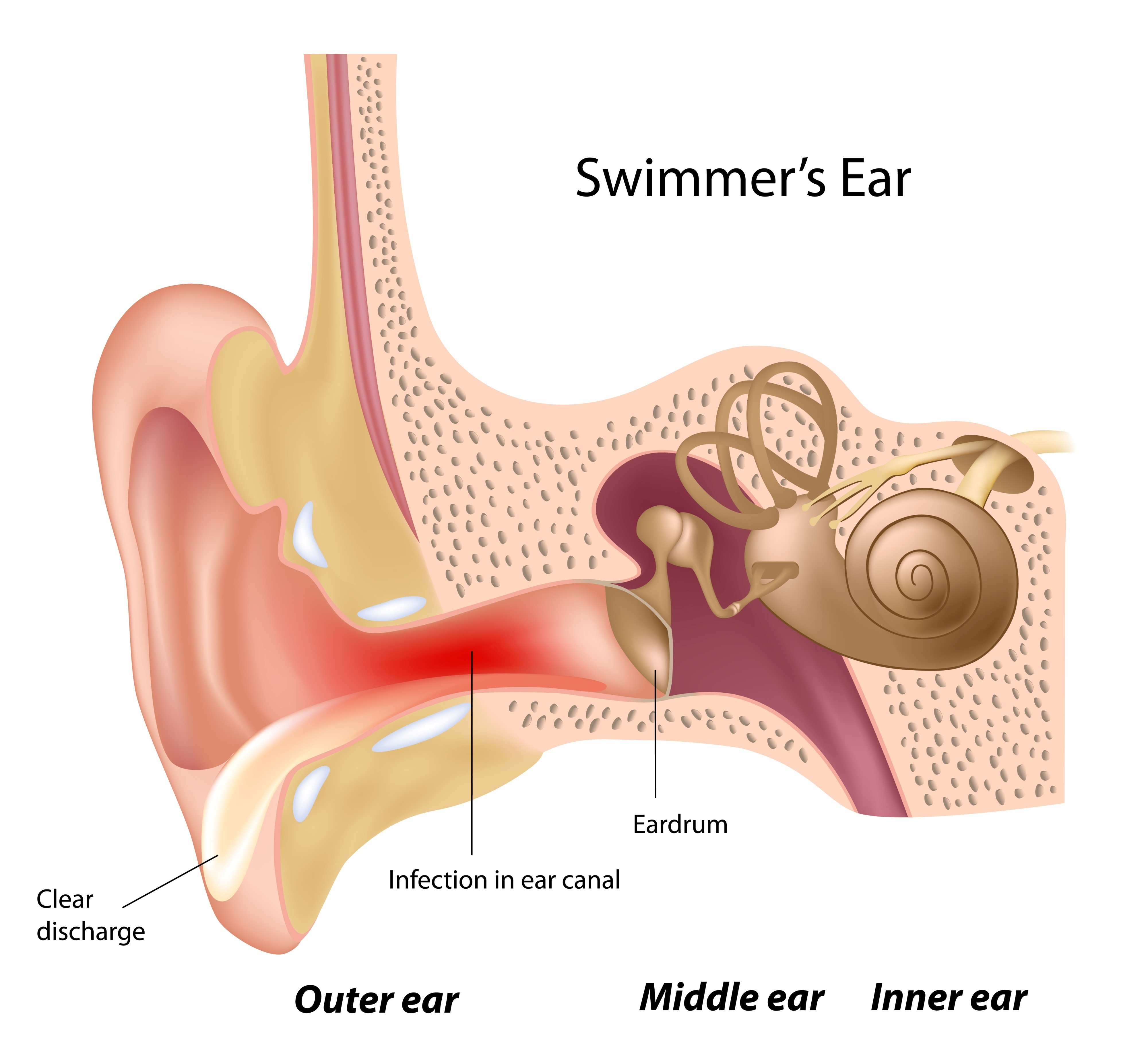 Outer_Ear_Infection_Swimmers_Ear_Diagram