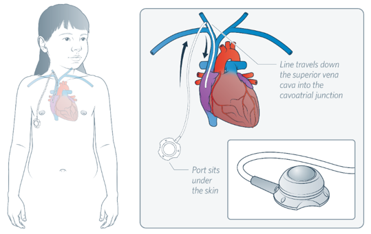 Venous Access