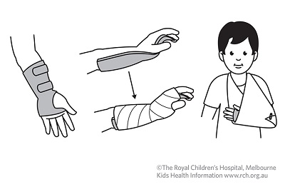 Fracture care: buckle fracture cast