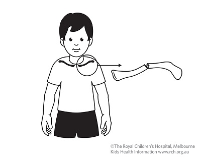 Fracture care: clavicle