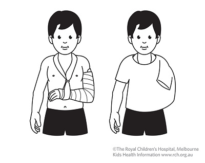 Fracture care: supracondular elbow sling