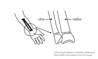 Fracture care: wrist