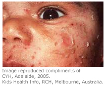 impetigo in children face