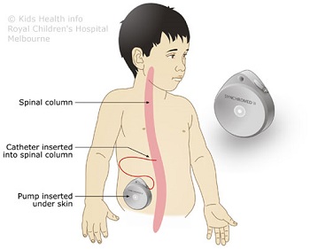 Intrathecal baclofen