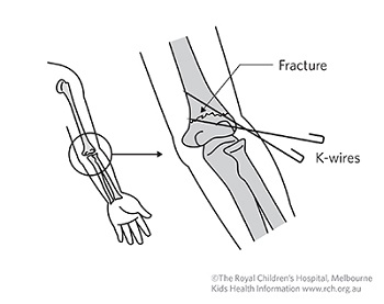k-wires-fracture