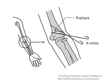 Kids Health Information : Kirschner wires (K-wires)