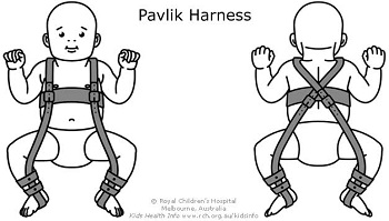 أحزمة Pavlik لـ DDH