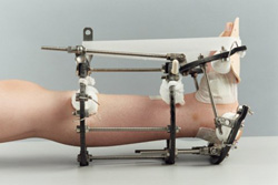 Limb reco 006.jpg