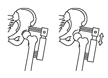 Distractor fixed to pelvis