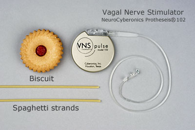 Vagus Nerve Stimulation (VNS)