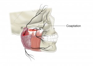 Coaptation facial palsy image