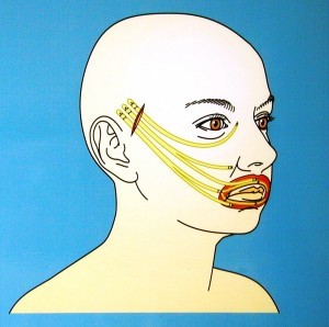 Figure 4 facial palsy image