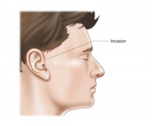 Figure 5 facial palsy image