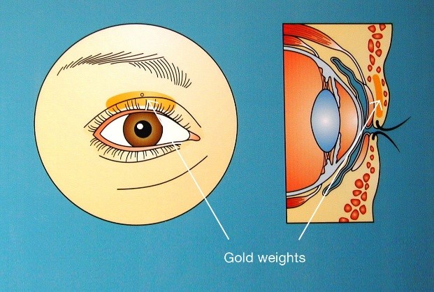 Gold weight facial palsy image