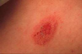 eczema - discoid 1