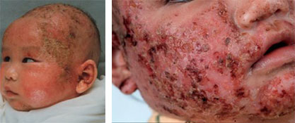 eczema - infected