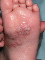 eczema - infected foot