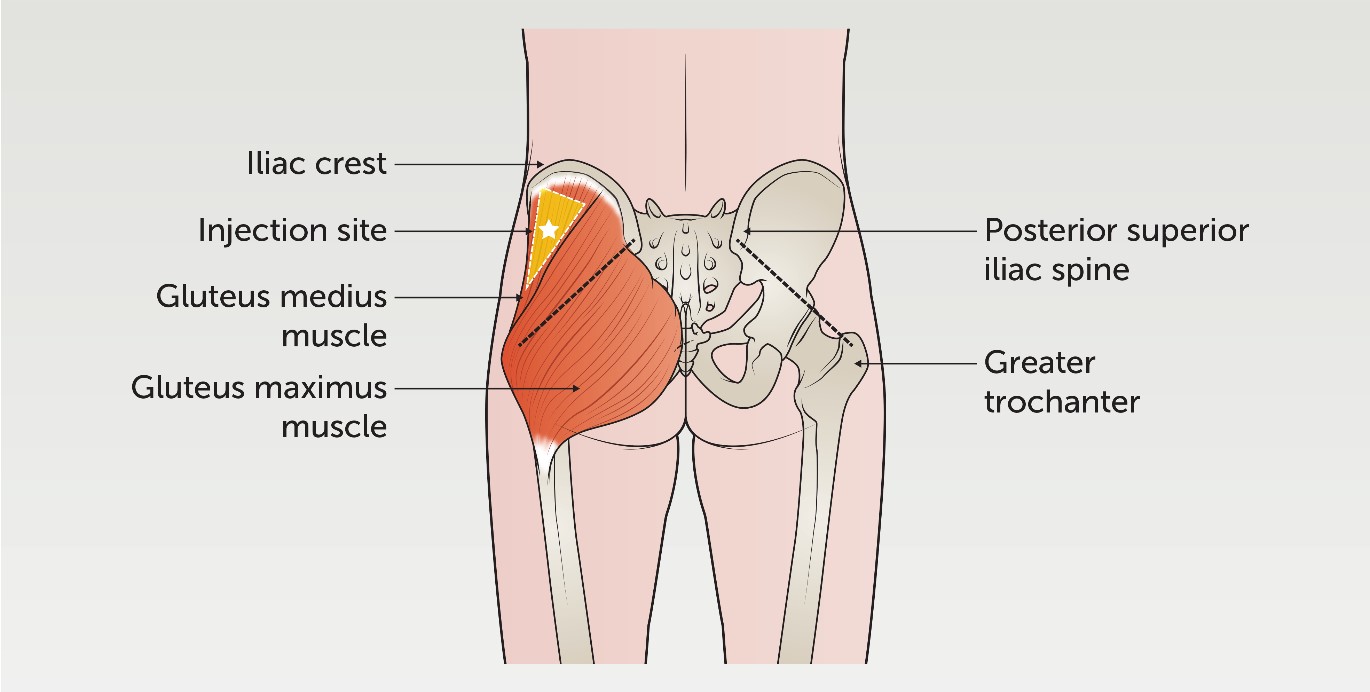 a) Comparison between thighs, deep intramuscular, slight