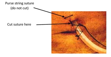 Suture