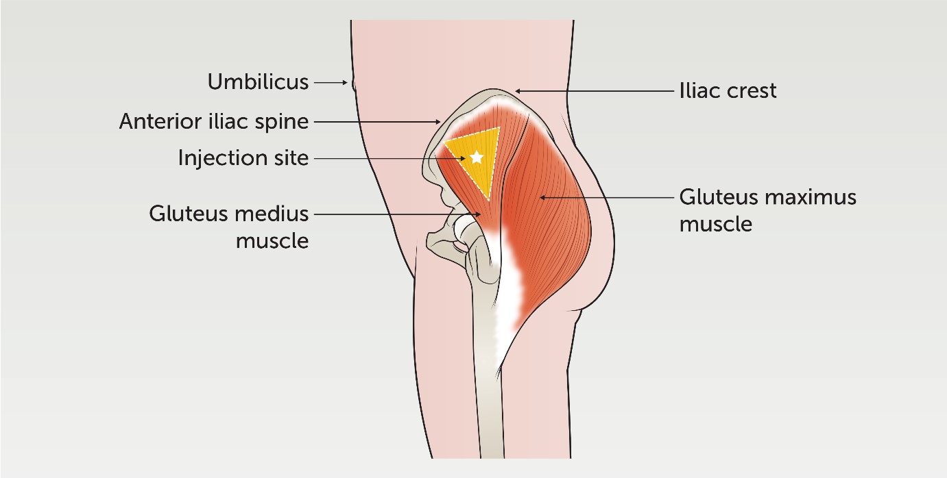 vastus lateralis injection