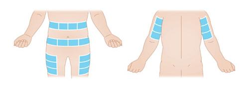 Clinical Guidelines (Nursing) : Subcutaneous catheter devices ...