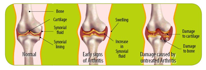 Damaged Arthritis