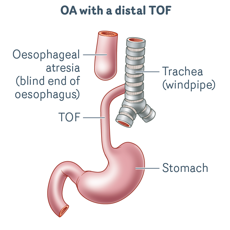 OA-with-a-distal-TOF