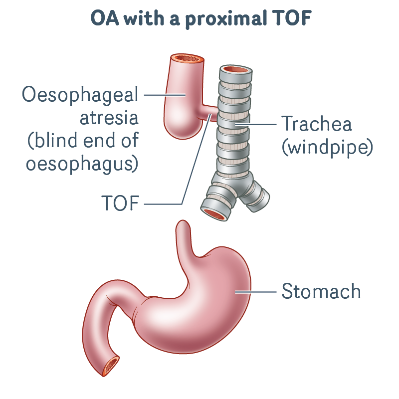 OA-with-a-proximal-TOF