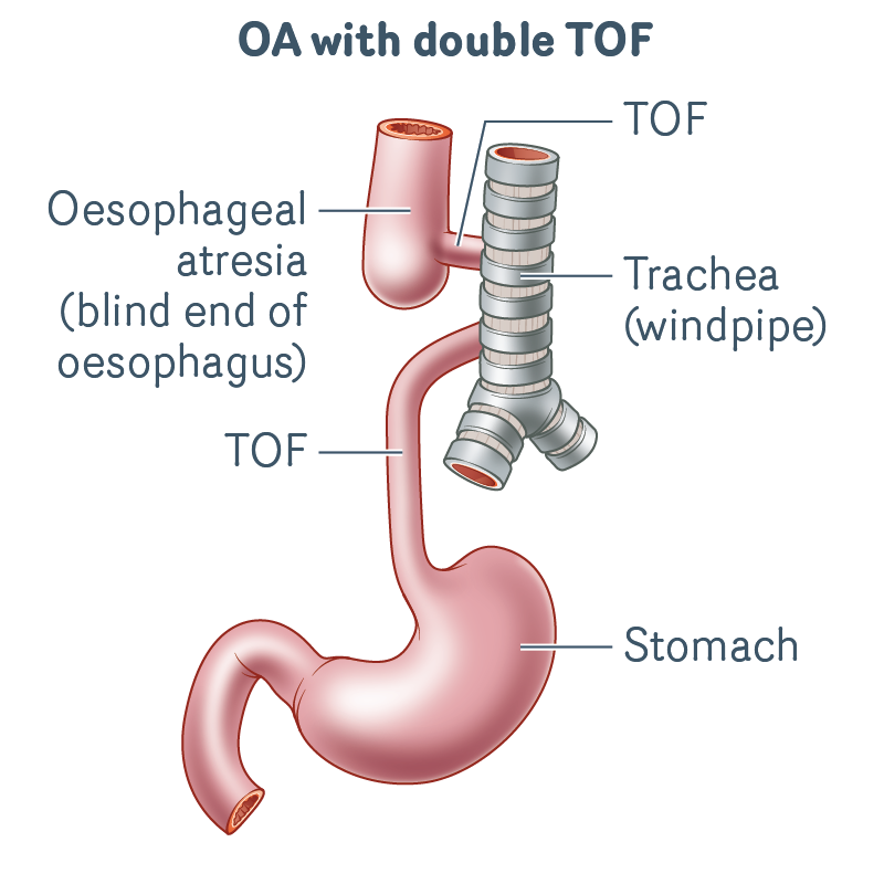 OA-with-double-TOF