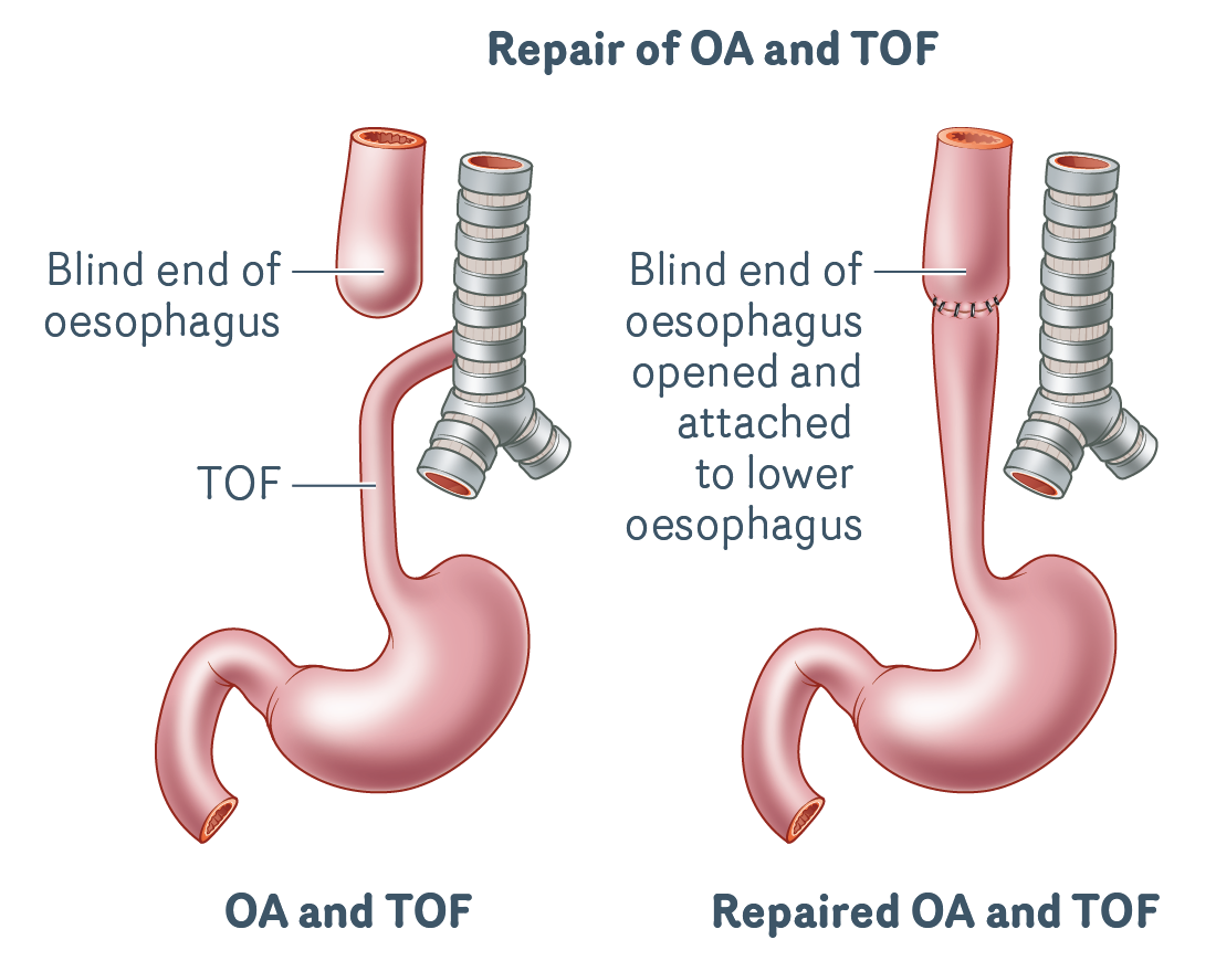 Repair-of-OA-and-TOF
